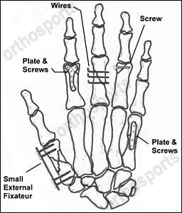 Hand - Hand Fractures 